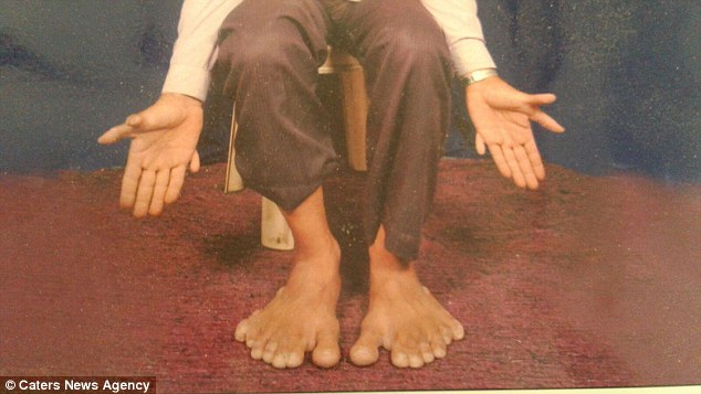 Человек с самым большим в мире количеством пальцев на руках и ногах