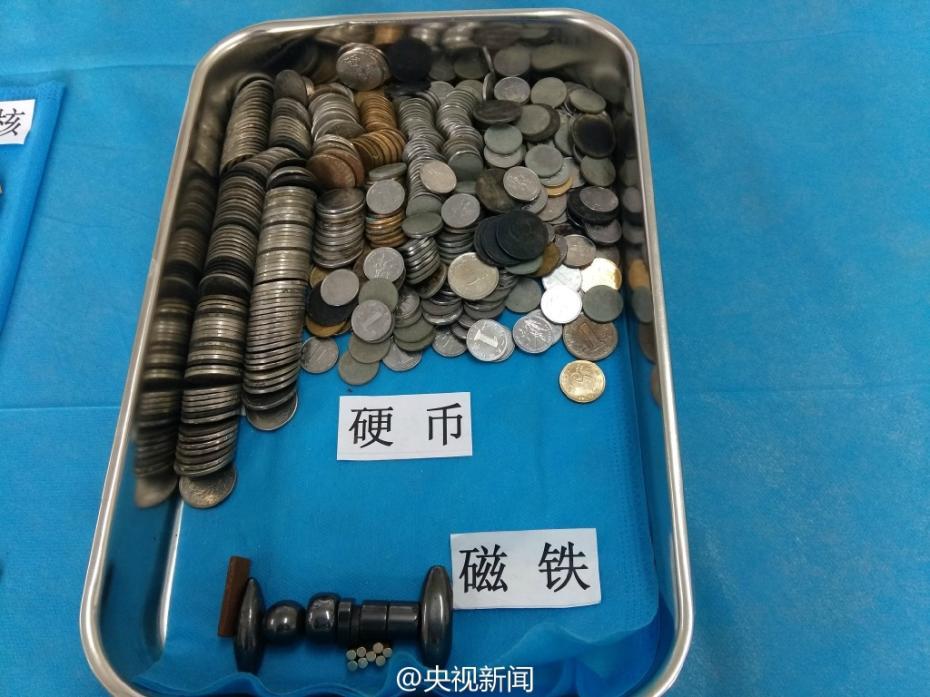 Невозможно поверить! Предметы, проглоченные детьми